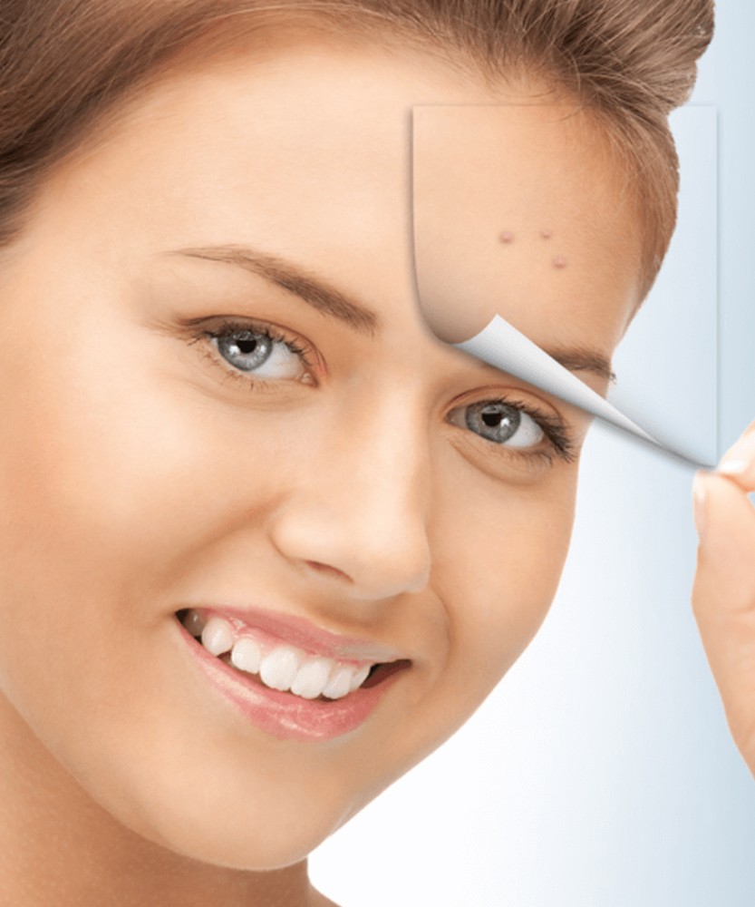 Liệu trình trị mụn sử dụng công nghệ RF